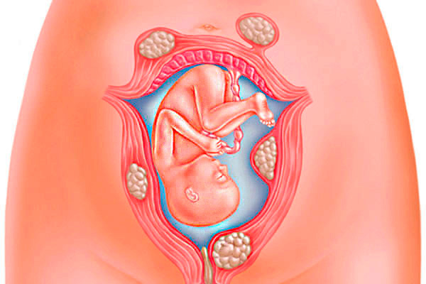 Беременность при миоматозных узлах разного расположения
