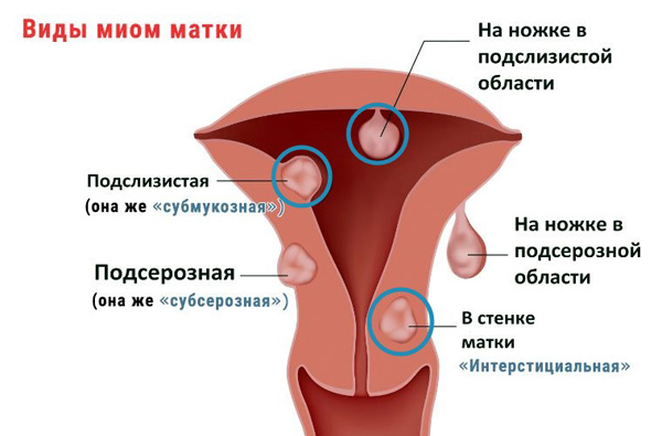 Миоматозные узлы, которые обязательно нужно удалять перед процедурой ЭКО