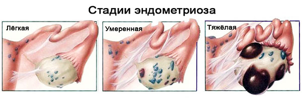 Стадии эндометриоза