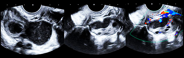УЗИ-снимок фолликулярной кисты обоих яичников