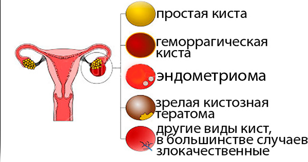 Типы опухолевидных образований яичника